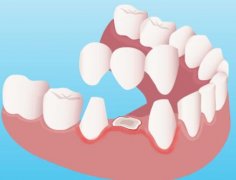天津烤瓷牙冠多少钱一颗