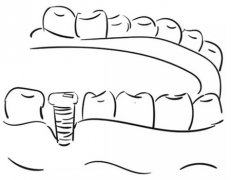哈尔滨种牙多少钱一颗啊