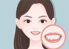 苏州牙齿矫正收费标准